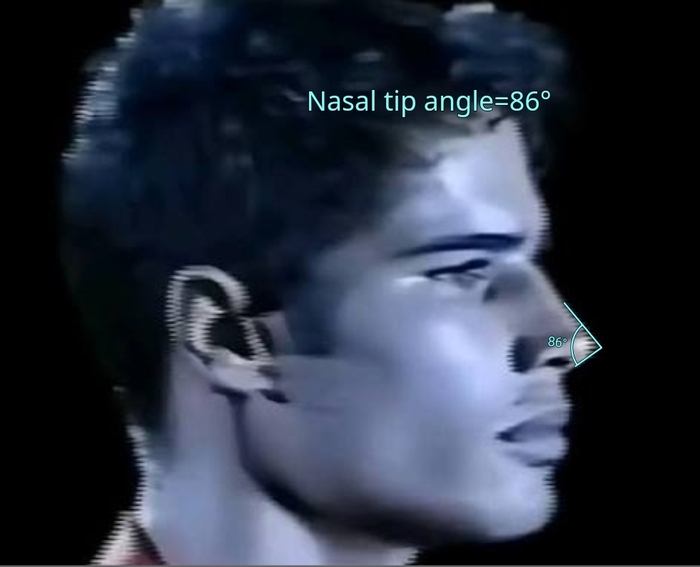 nasal tip angle.jpg