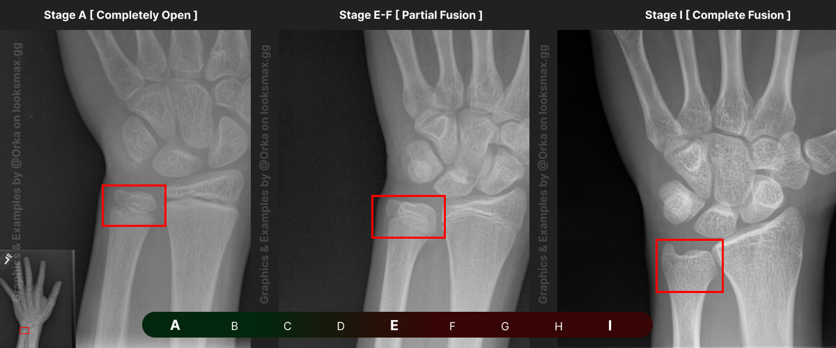 Template 2_ Bonetype_ Ulna (distal end).png